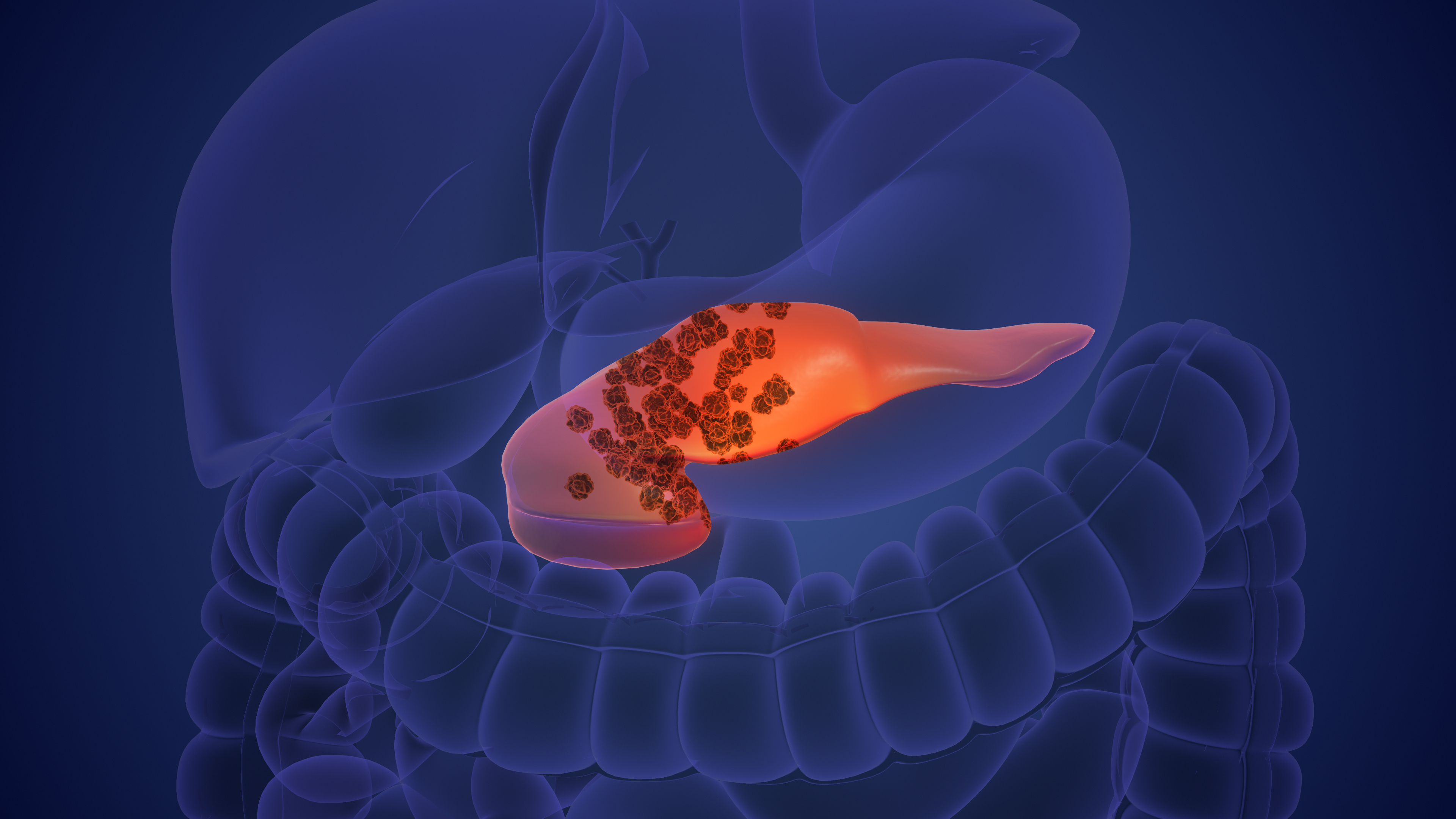 AI prevede tumore al pancreas